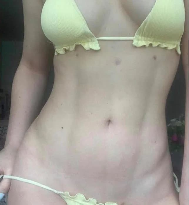 After Tummy Tuck results — YCS Aesthetic Center Hialeah