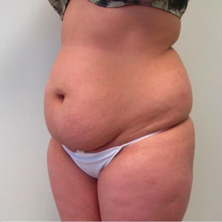 Before Tummy Tuck — patient result at Your Cosmetic Surgery & SPA, Miami
