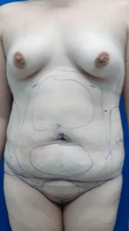 Before Tummy Tuck at YCS Aesthetic Center, Miami