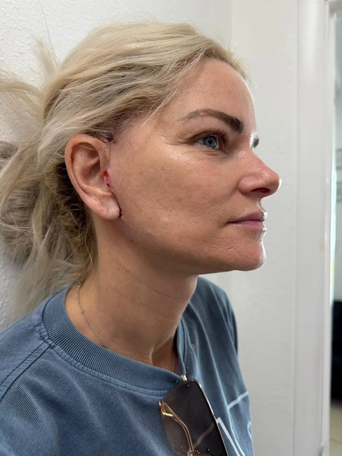 After — real patient facelift result, Case 1 — Female, 58, at Your Cosmetic Surgery & SPA in Miami