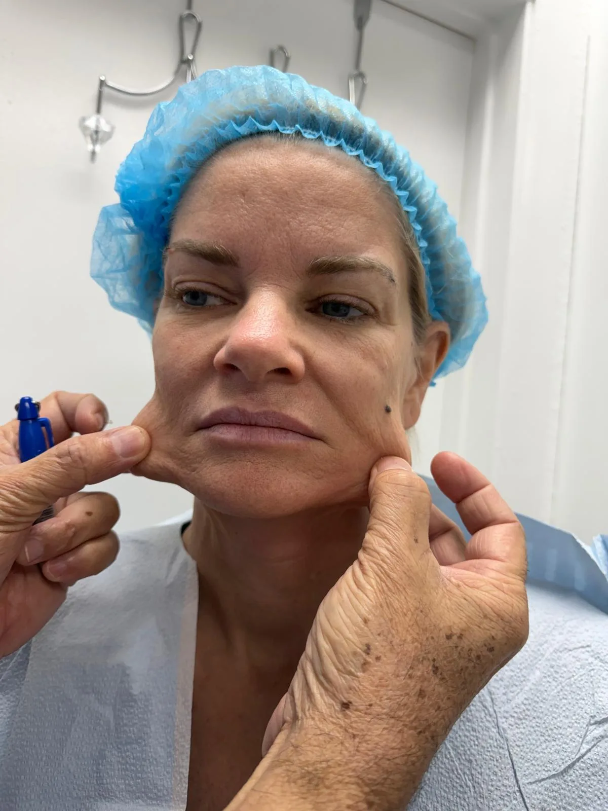 Before — real patient facelift result, Case 1 — Female, 58, at Your Cosmetic Surgery & SPA in Miami