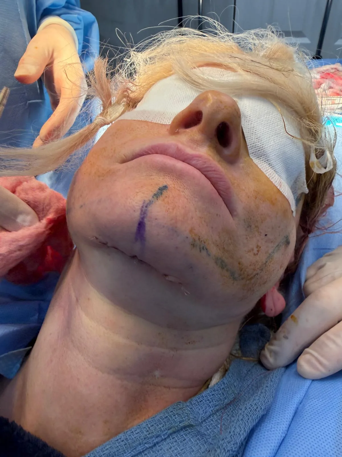 During — real patient facelift result, Case 1 — Female, 58, at Your Cosmetic Surgery & SPA in Miami