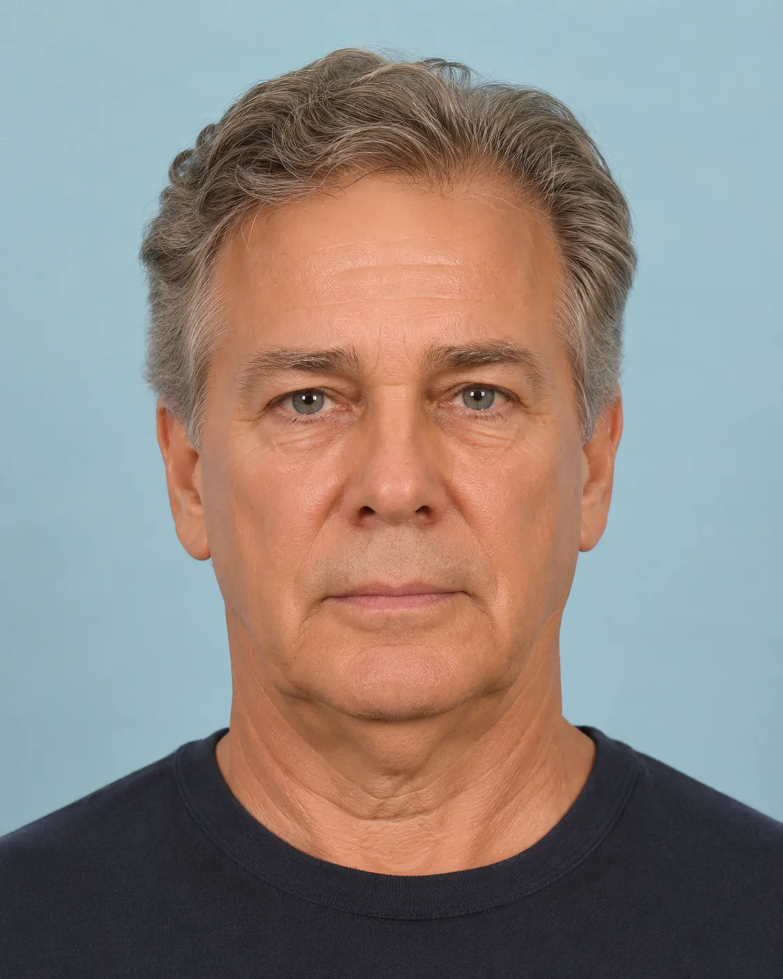 Before — real patient facelift result, Case 2 — Male, 64, at Your Cosmetic Surgery & SPA in Miami